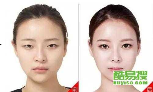 酒窝埋线视频,打造迷人酒窝的神奇之旅